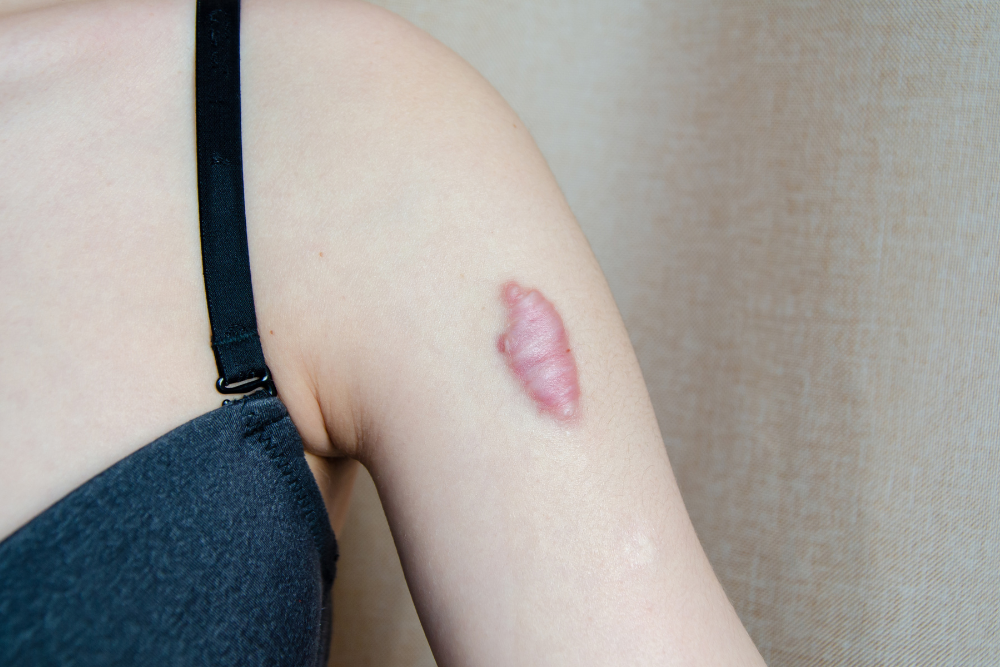 KELOID REMOVAL SURGERY